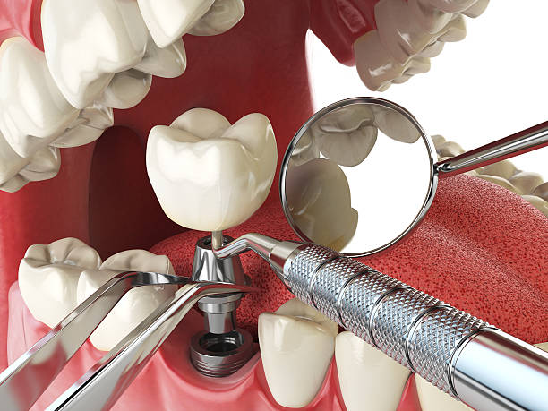 Best Emergency Treatment for Dental Infections or Abscesses in Egan, LA